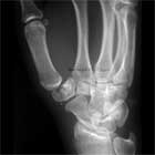 trapezium fracture xray