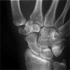trapezium fracture xray