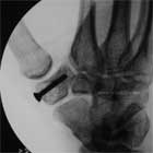 ORIF trapezium fracture xray