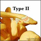 Type II AC joint separation