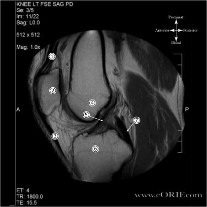 Proton Density MRI of Normal ACL Proton Density MRI of Normal ACL