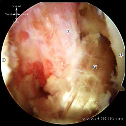 ACL reconstruction image ACL reconstruction image