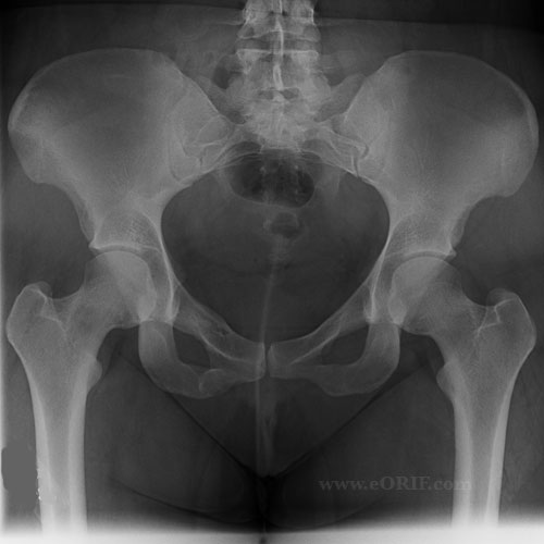 A/P pelvis xray