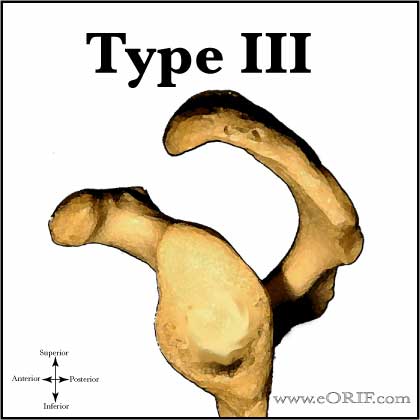 Type 3 acromioin