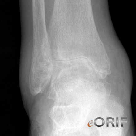 ankle arthritis Ankle arthritis xray