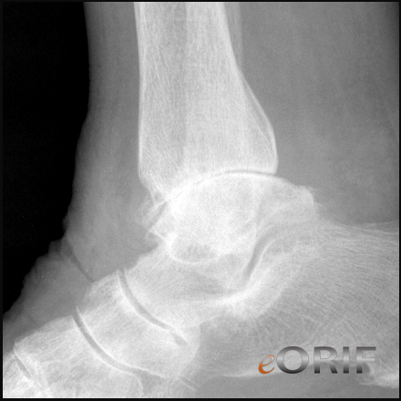 Ankle arthritis lateral view Ankle arthritis lateral view xray
