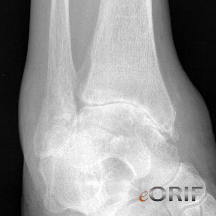 Ankle arthritis oblique view Ankle arthritis oblique view xray