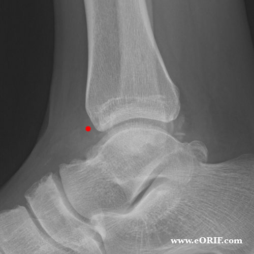 Anterior ankle impingement xray Anterior ankle impingement xray