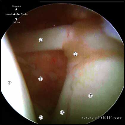 biceps labral complex arthroscopic picture