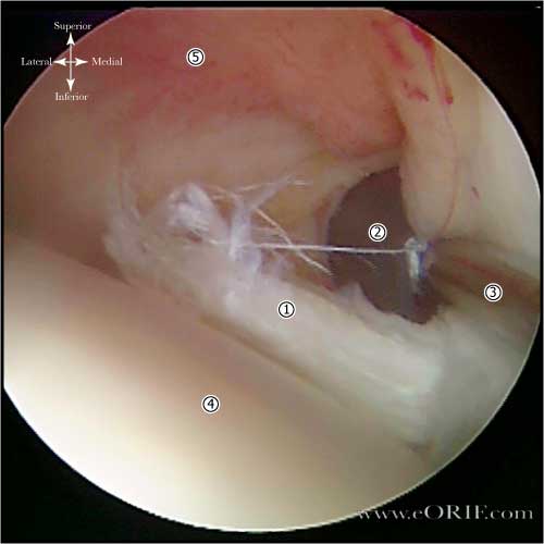 biceps tendonitis picture