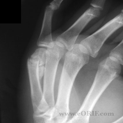 Metacarpal neck fracture nonunion xray