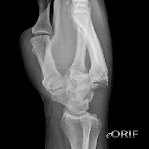 carpometacarpal dislocation carpometacarpal dislocation
