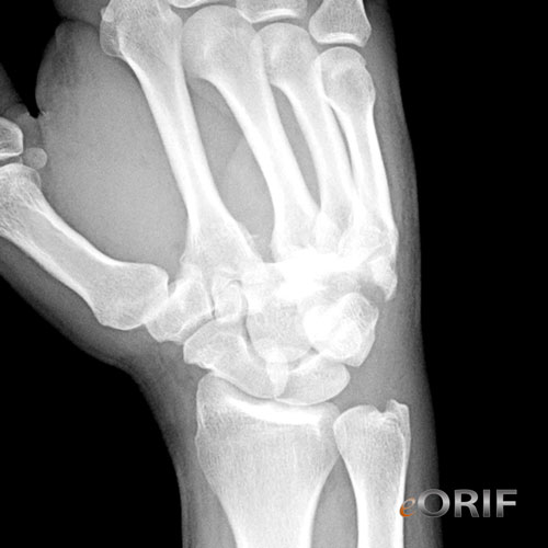 cmc dislocation cmc dislocation