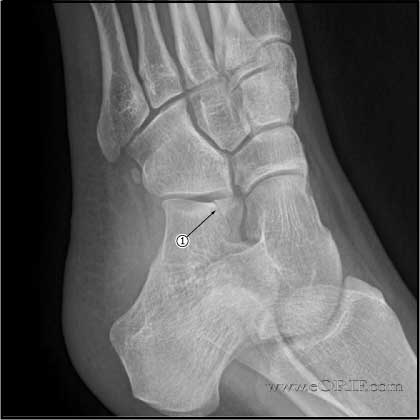 Anterior process calcaneus fracture Anterior process calcaneus fracture xray