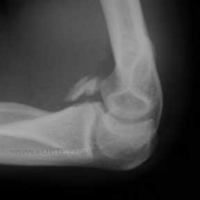 Type III coronoid fracture xray Type III coronoid fracture xray