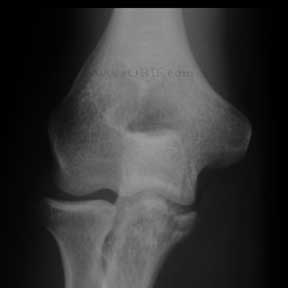 Type III coronoid fracture xray Type III coronoid fracture xray