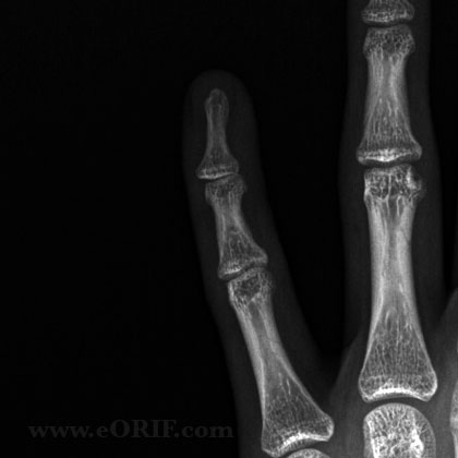 Dip dislocation xray DIP Dislocation xray