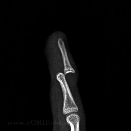 DIP dislocation xray DIP dislocation xray