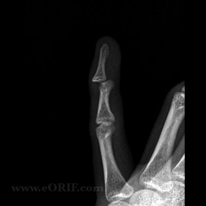 DiIP dislocation lateral view DIP dislocation lateral view xray