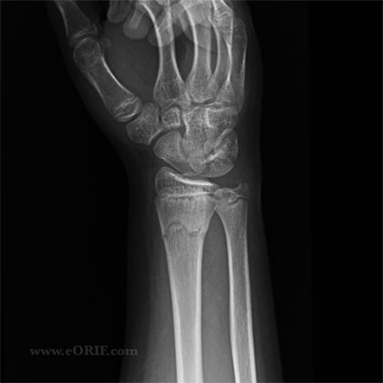 Pediatric Distal Radius Fracture