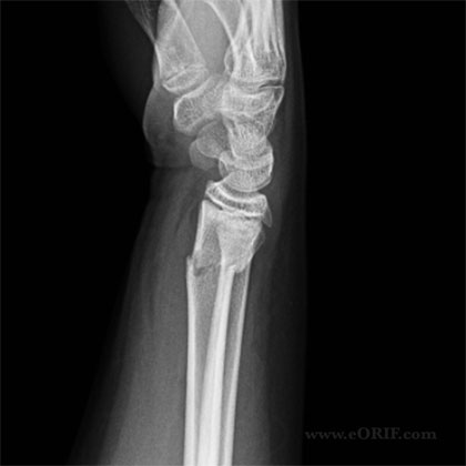 Lateral view pediatric distal radius fracture