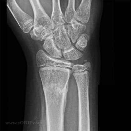 AP xray distal radius fracture