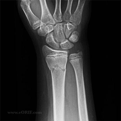 A/P xray pediatric distal radius fracture