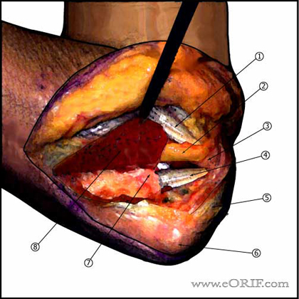 elbow posterior approach elbow posterior approach