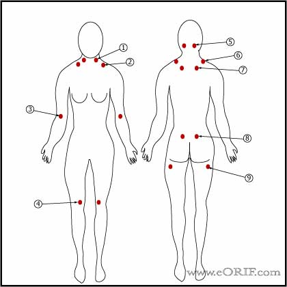 Fibromyalgia trigger point image