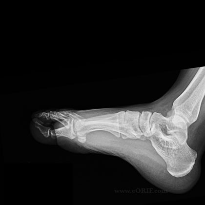 Foot lateral xray Foot lateral view xray