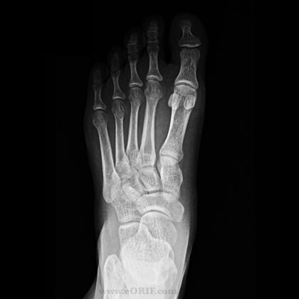 Foot A/P xray Foot A/P view xray