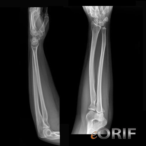 forearm xray