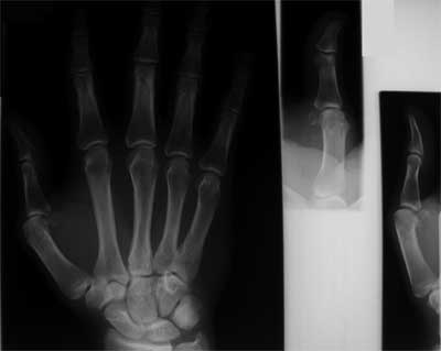 Gamekeeper's thumb xray Gamekeeper's thumb xray