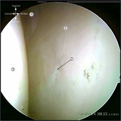 glenoid arthscopic picture