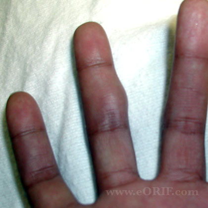 ganglion of the tendon sheath
