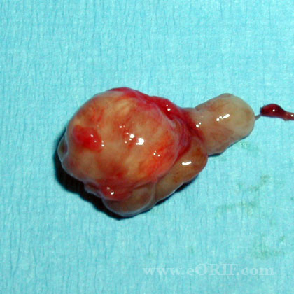 Giant cell tumor clinic photo
