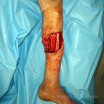 Grade 3A open tibial shaft fracture image