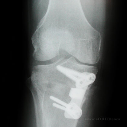 HTO xray