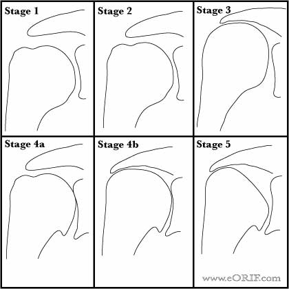 Hamada Classification picture