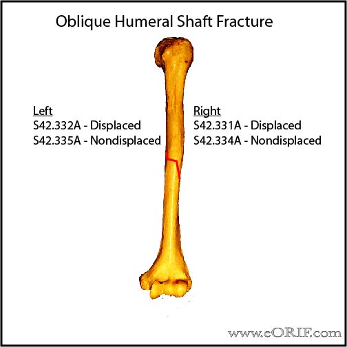 oblique humeral shaft fracture classification ICD-10 oblique humeral shaft fracture classification ICD-10