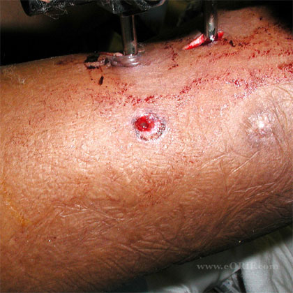 Humeral shaft GSW Humeral shaft gun shot entrance wound