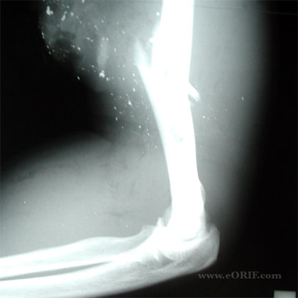 Humeral shaft fracture GSW xray Humeral shaft fracture gun shot X-ray