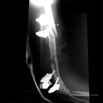 humeral shaft fracture xray humerus fracture xray