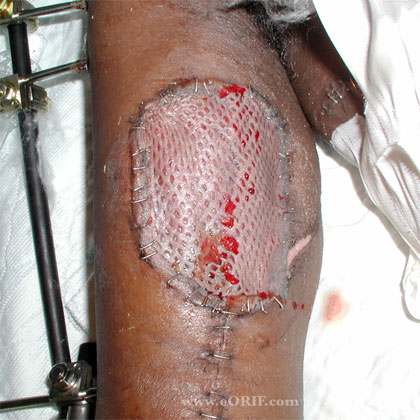 GSW skin graft gun shot wound skin graft