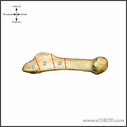 Jones fracture classification Jones Fracture classification image