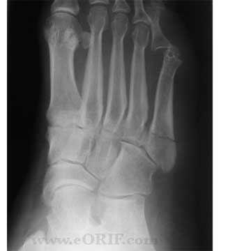 Jones fracture xray Jones fracture xray image
