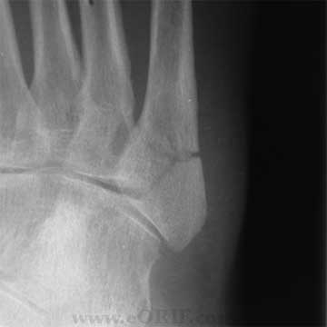 Jones fracture xray Jones fracture xray