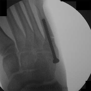 Jones fracture ORIF image Jones fracture screw fixation xray image