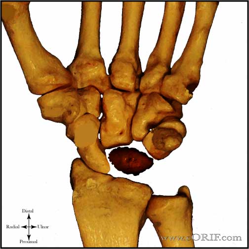 Kienbocks Disease Stage 3B Kienbocks Disease Stage 3B