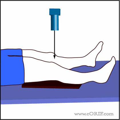 ap knee xray technique